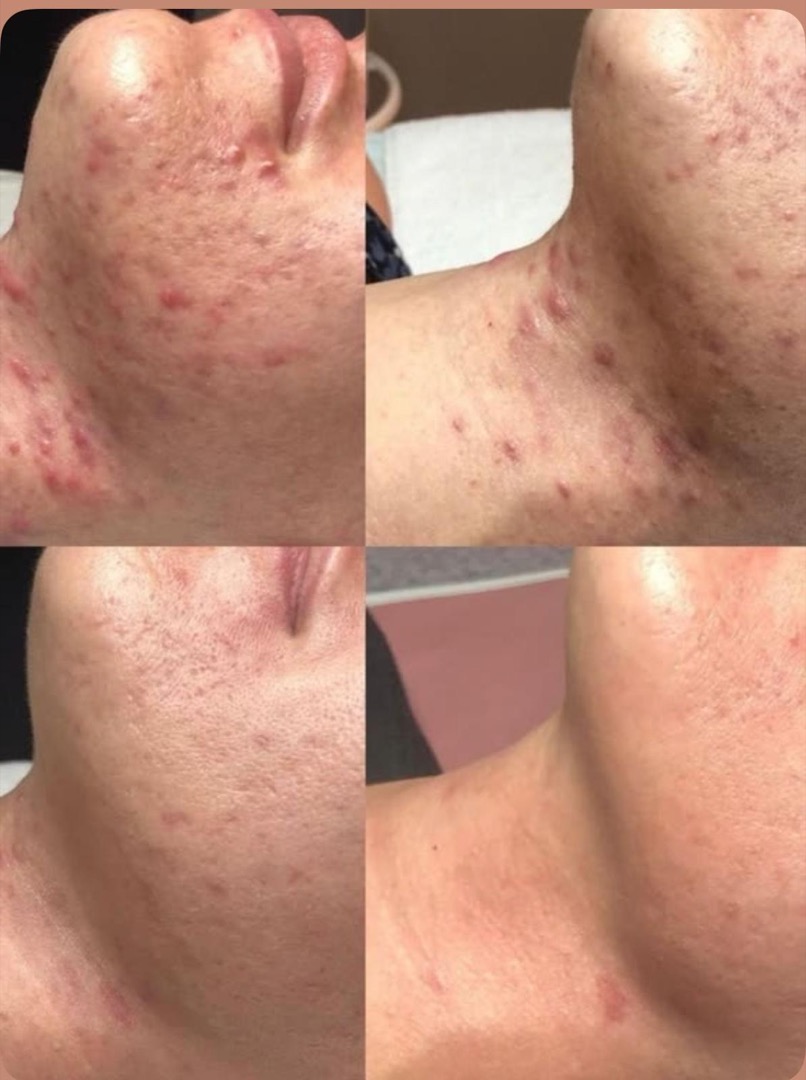 Antes y después del tratamiento antiacné con dermapen