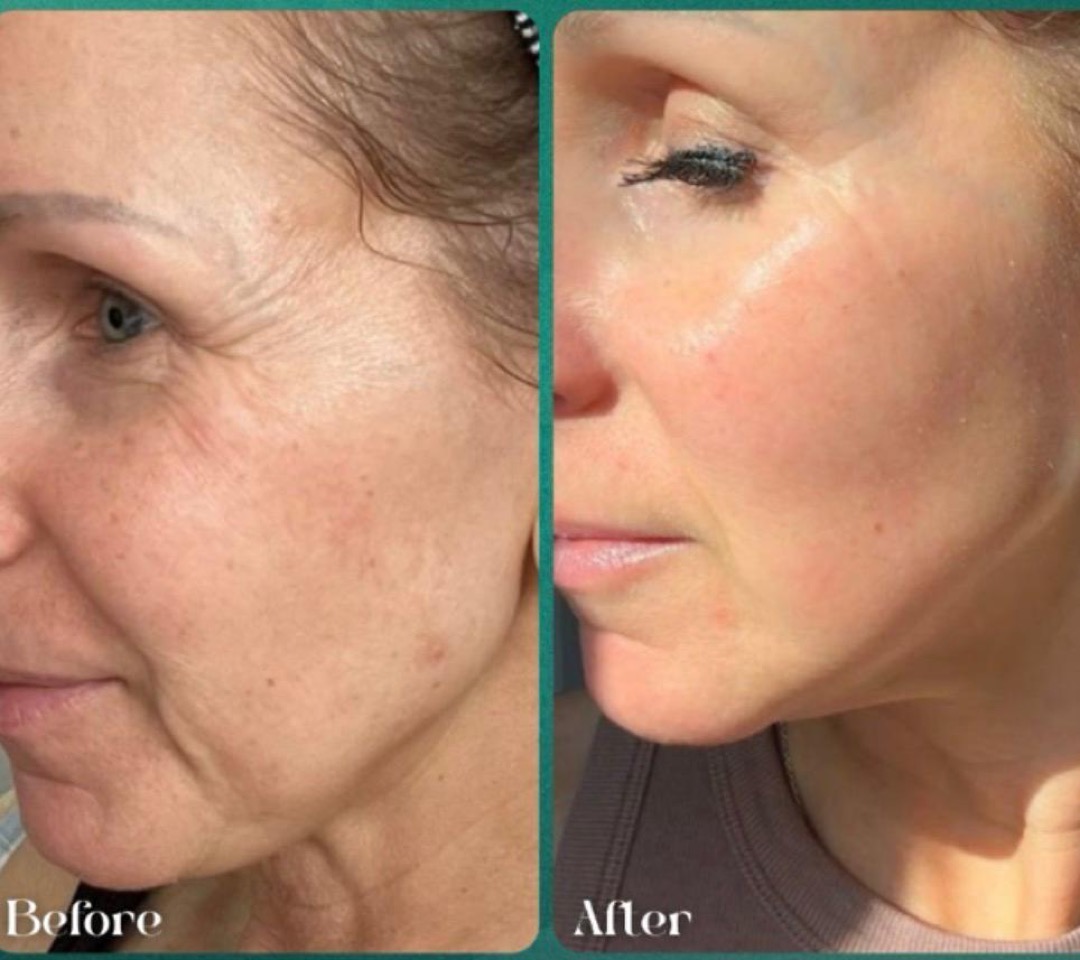 Antes y después · contorno de ojos y mejillas con Láser No Ablativo