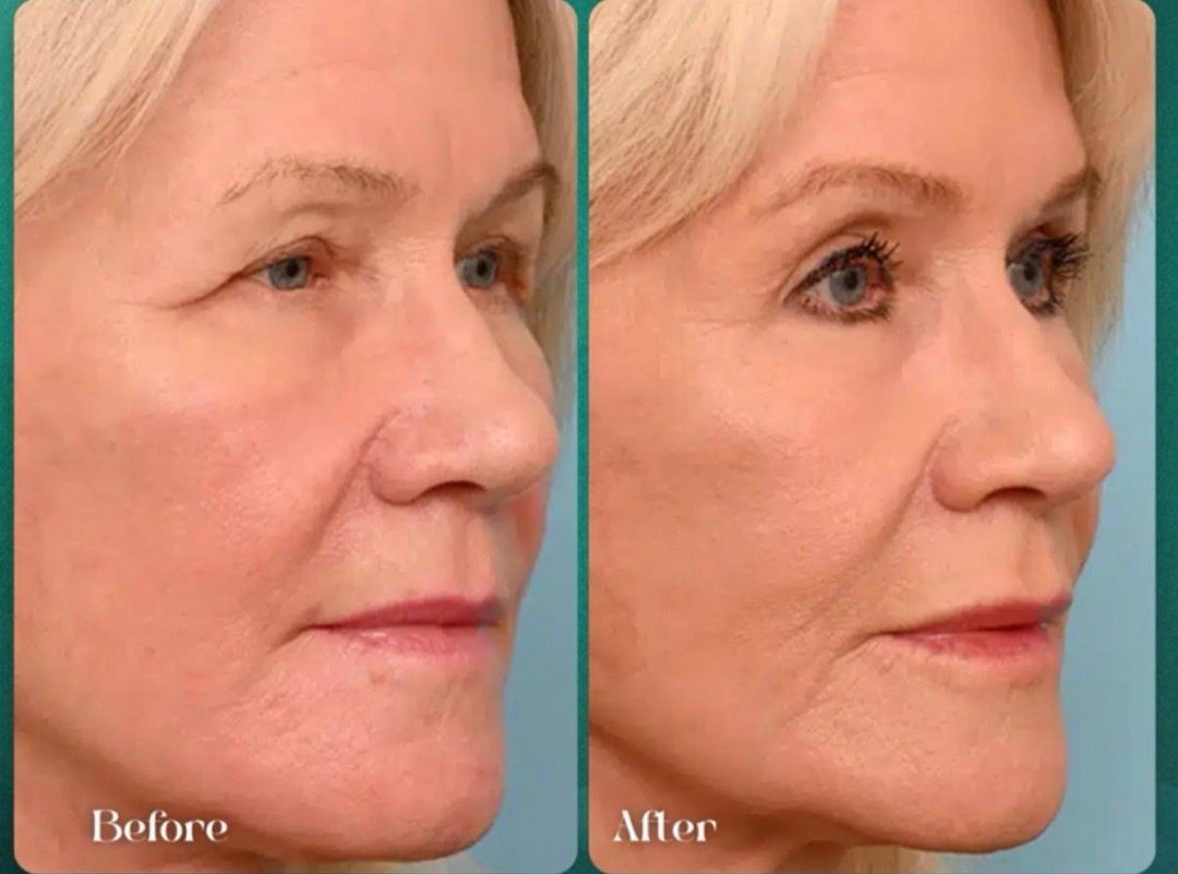 Antes y después · rejuvenecimiento facial con Láser No Ablativo